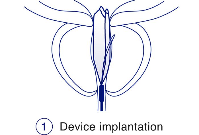 MT08 (1) Device Implantation